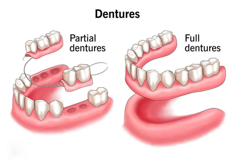 Common Challenges with Dentures and How to Overcome Them