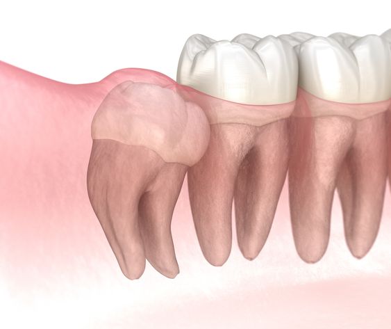 Wisdom Teeth Removal