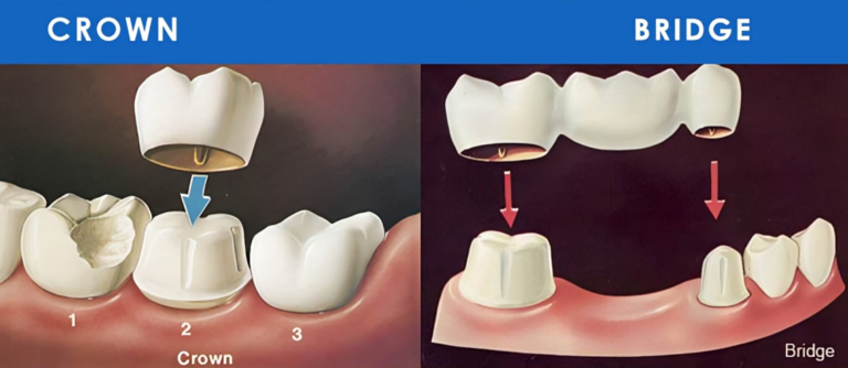 Crafting Smiles A Comprehensive Guide to Crowns and Bridges in Dentistry.