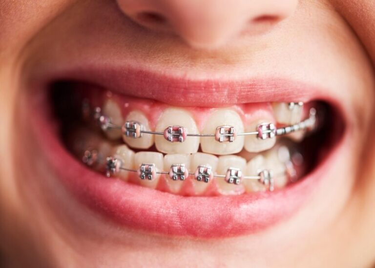 Braces & aligners