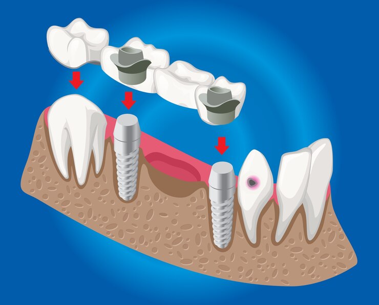 Crown And Bridge Dentistry